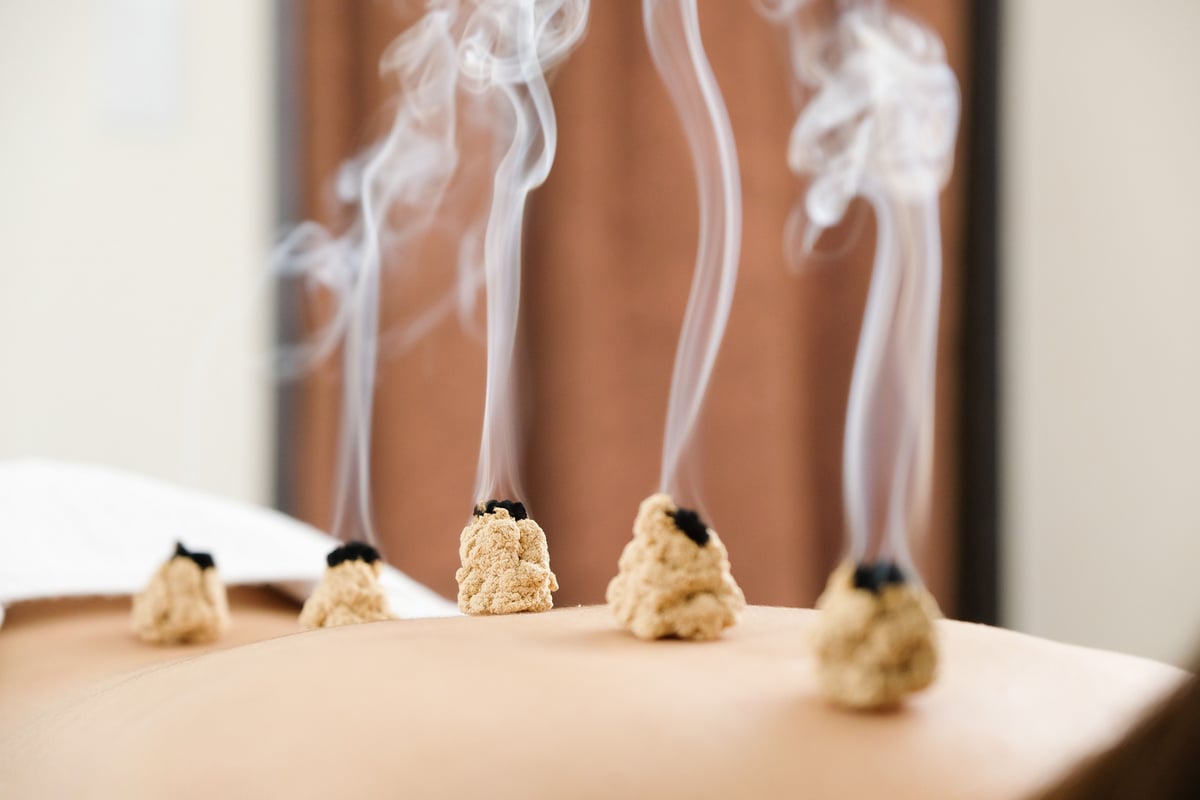 Acupuncture and moxibustion on the back of a woman in a bright acupuncture center